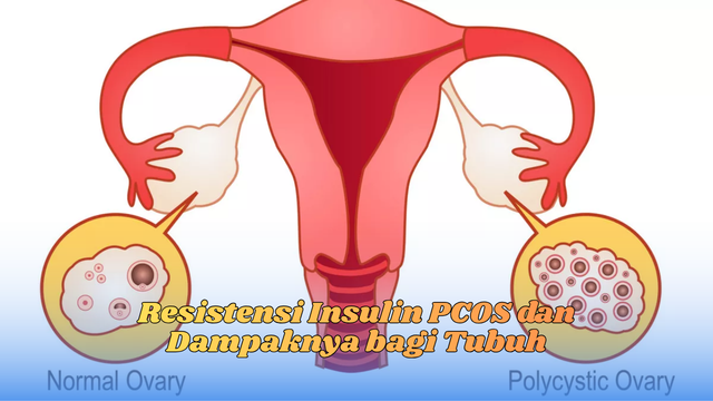 resistensi insulin pcos